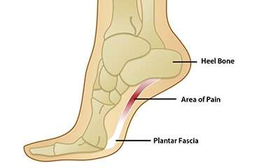 Fascia Injury