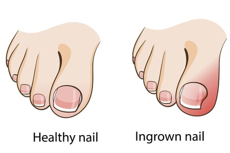 Do Steel Toe Boots Cause Ingrown Toe Nails