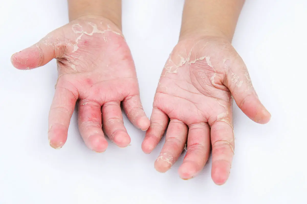 dry hands from wearing gloves